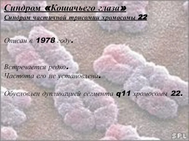 Синдром «Кошачьего глаза» Синдром частичной трисомии хромосомы 22 Описан в 1978 году.