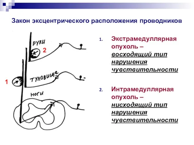 Закон эксцентрического расположения проводников Экстрамедуллярная опухоль – восходящий тип нарушения чувствительности Интрамедуллярная