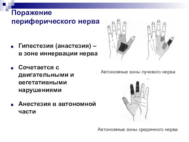 Поражение периферического нерва Гипестезия (анастезия) – в зоне иннервации нерва Сочетается с