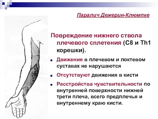 Паралич Дежерин-Клюмпке Повреждение нижнего ствола плечевого сплетения (С8 и Th1 корешки). Движения