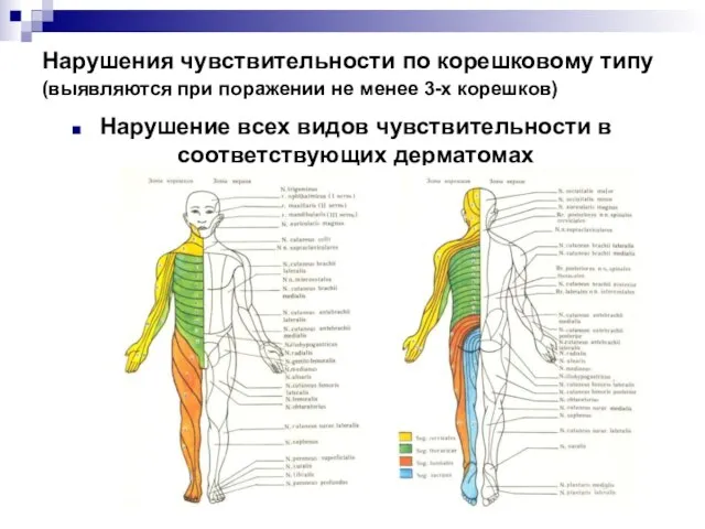 Нарушения чувствительности по корешковому типу (выявляются при поражении не менее 3-х корешков)