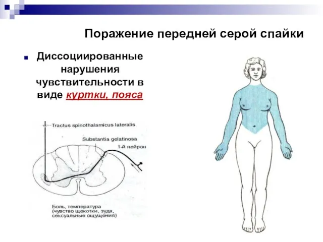 Поражение передней серой спайки Диссоциированные нарушения чувствительности в виде куртки, пояса