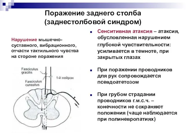 Поражение заднего столба (заднестолбовой синдром) Сенситивная атаксия – атаксия, обусловленная нарушением глубокой