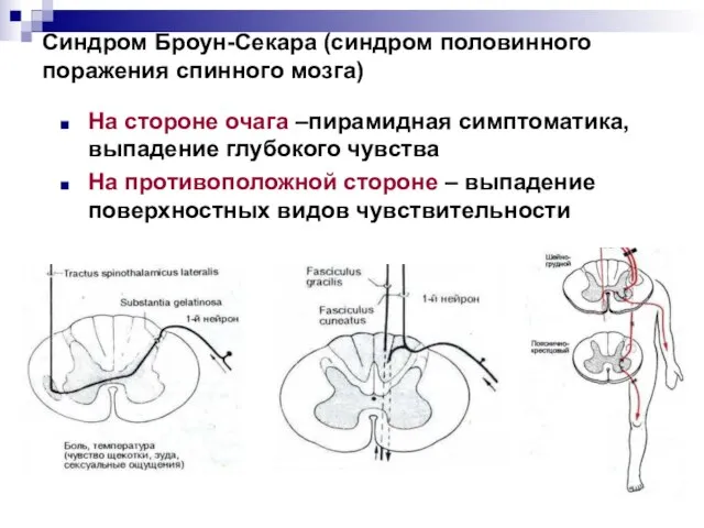 Синдром Броун-Секара (синдром половинного поражения спинного мозга) На стороне очага –пирамидная симптоматика,