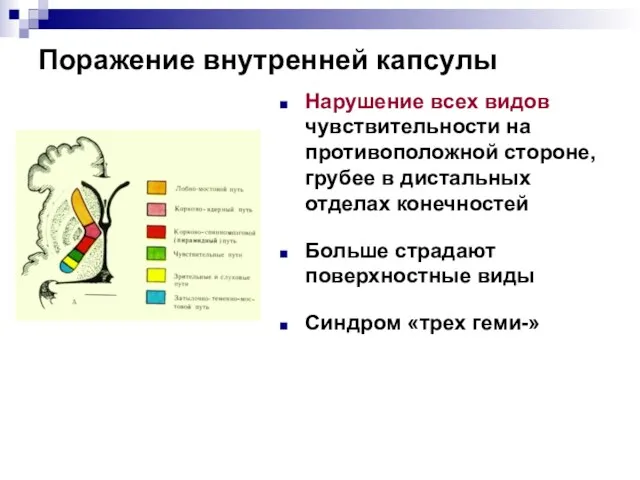 Поражение внутренней капсулы Нарушение всех видов чувствительности на противоположной стороне, грубее в