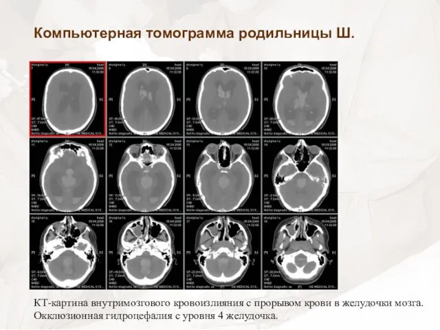 Компьютерная томограмма родильницы Ш. КТ-картина внутримозгового кровоизлияния с прорывом крови в желудочки