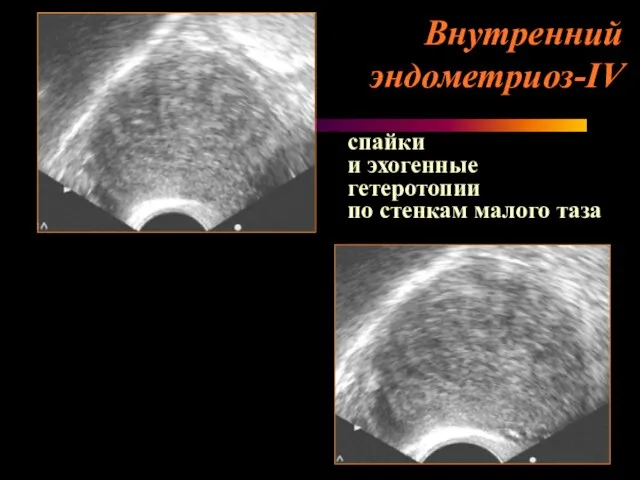 Внутренний эндометриоз-IV спайки и эхогенные гетеротопии по стенкам малого таза