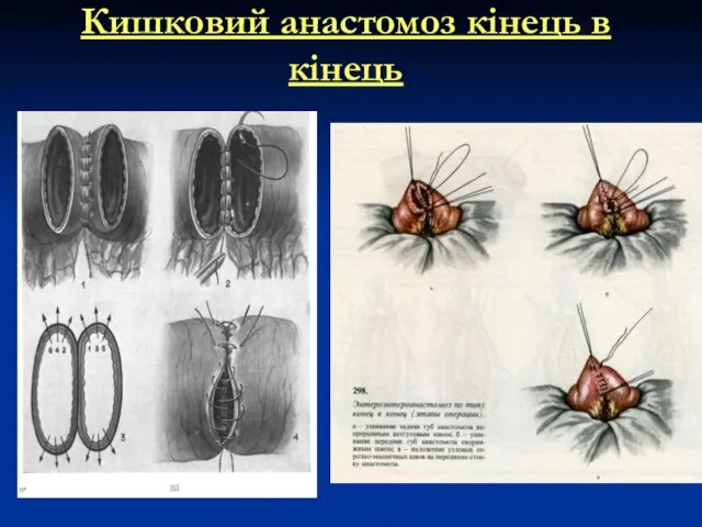 Кишковий анастомоз кінець в кінець