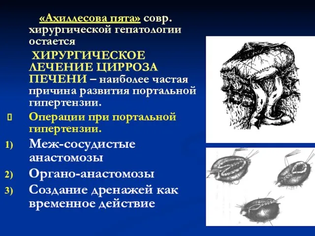 «Ахиллесова пята» совр.хирургической гепатологии остается ХИРУРГИЧЕСКОЕ ЛЕЧЕНИЕ ЦИРРОЗА ПЕЧЕНИ – наиболее частая