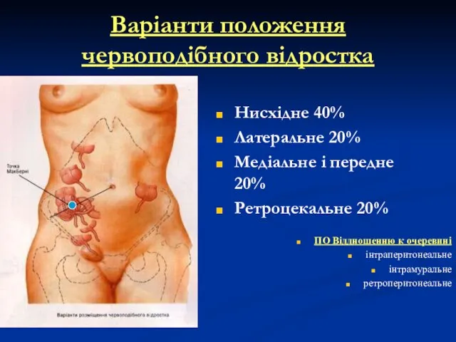 Варіанти положення червоподібного відростка Нисхідне 40% Латеральне 20% Медіальне і передне 20%