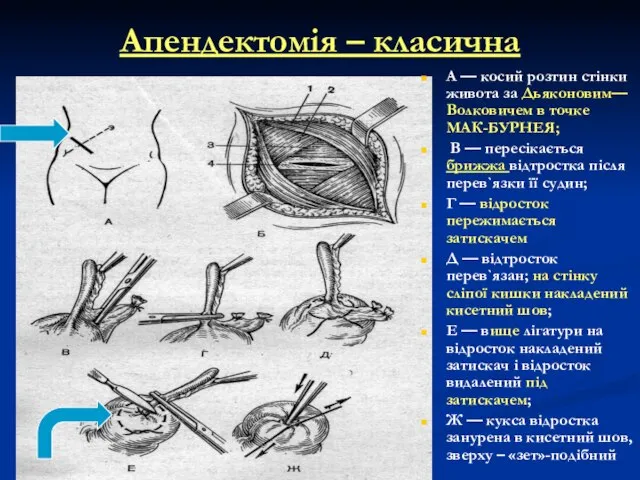 Апендектомія – класична А — косий розтин стінки живота за Дьяконовим—Волковичем в