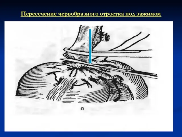 Пересечение червобразного отростка под зажимом