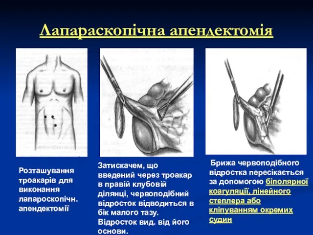 Лапараскопічна апендектомія Розташування троакарів для виконання лапароскопічн. апендектомії Затискачем, що введений через