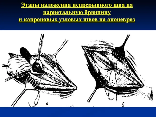 Этапы наложения непрерывного шва на париетальную брюшину и капроновых узловых швов на апоневроз