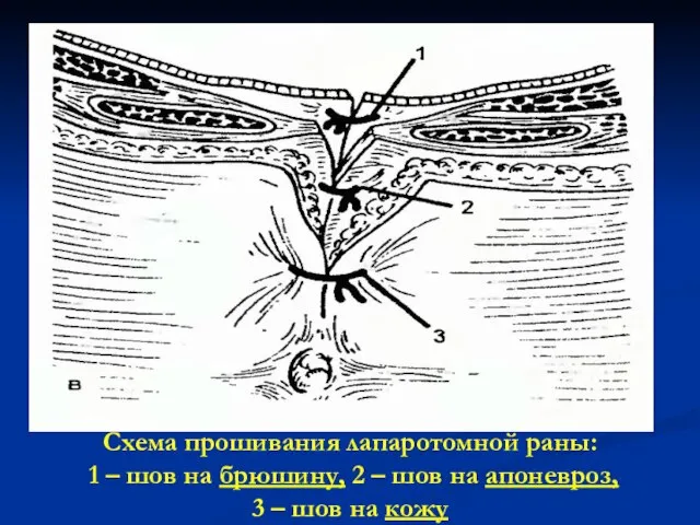 Схема прошивания лапаротомной раны: 1 – шов на брюшину, 2 – шов