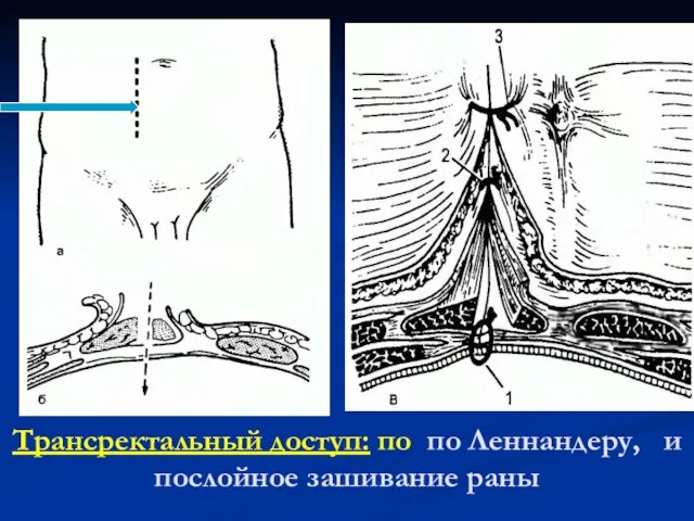 Трансректальный доступ: по по Леннандеру, и послойное зашивание раны