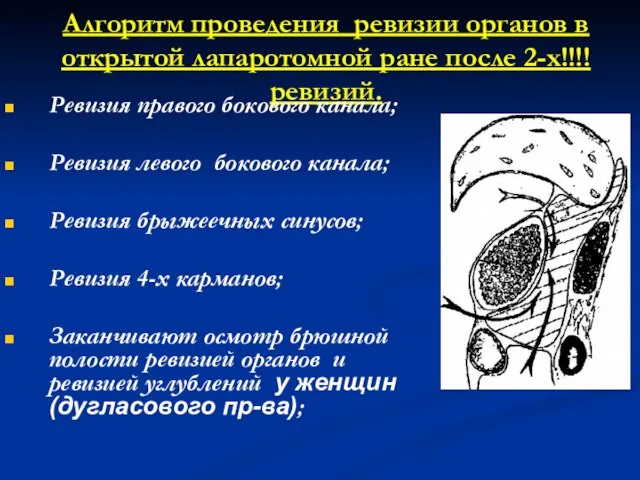 Алгоритм проведения ревизии органов в открытой лапаротомной ране после 2-х!!!! ревизий. Ревизия