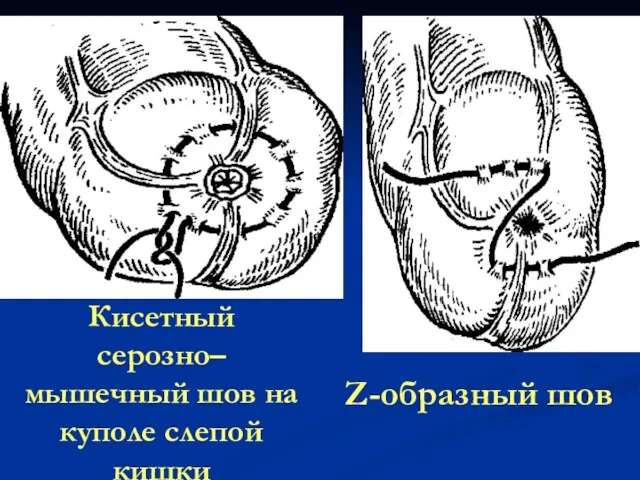 Кисетный серозно–мышечный шов на куполе слепой кишки Z-образный шов