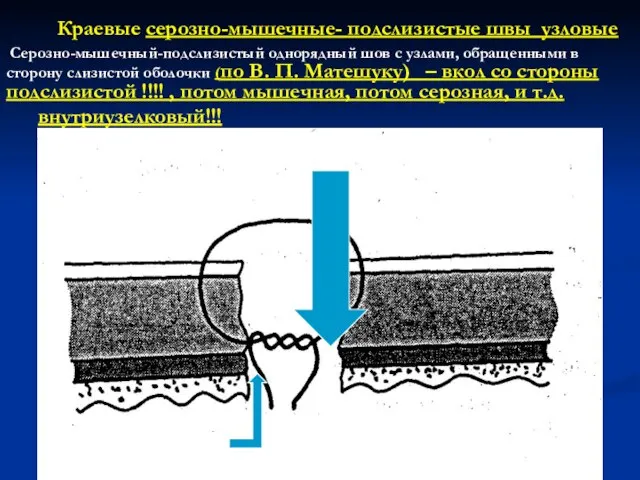 Краевые серозно-мышечные- подслизистые швы узловые Серозно-мышечный-подслизистый однорядный шов с узлами, обращенными в