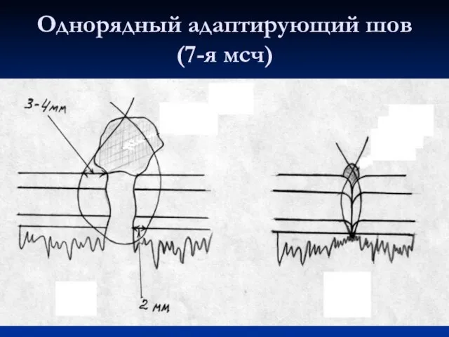 Однорядный адаптирующий шов (7-я мсч)