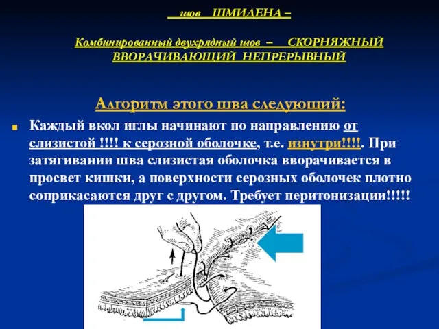 шов ШМИДЕНА – Комбинированный двухрядный шов – СКОРНЯЖНЫЙ ВВОРАЧИВАЮЩИЙ НЕПРЕРЫВНЫЙ Алгоритм этого