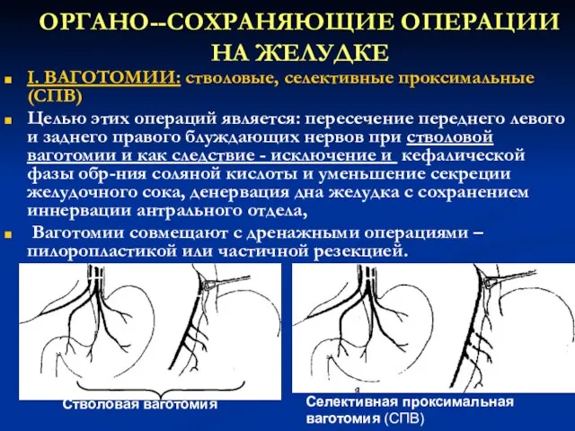 ОРГАНО--СОХРАНЯЮЩИЕ ОПЕРАЦИИ НА ЖЕЛУДКЕ I. ВАГОТОМИИ: стволовые, селективные проксимальные (СПВ) Целью этих