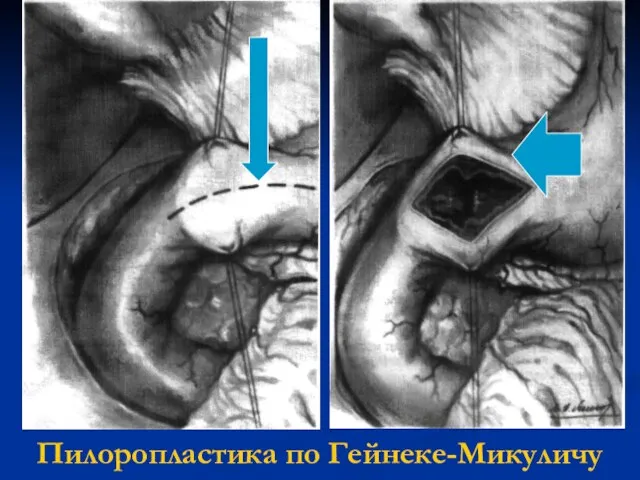 Пилоропластика по Гейнеке-Микуличу