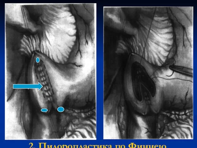 2. Пилоропластика по Финнею
