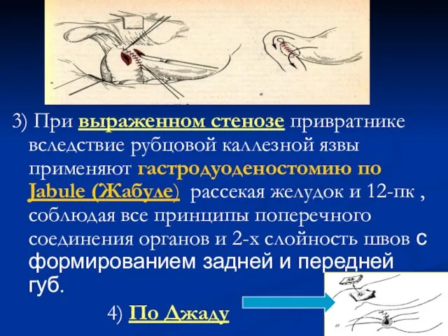 3) При выраженном стенозе привратнике вследствие рубцовой каллезной язвы применяют гастродуоденостомию по