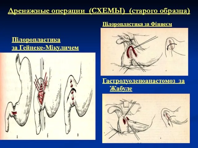 Дренажные операции (СХЕМЫ) (старого образца) Пілоропластика за Гейнеке-Мікуличем Пілоропластика за Фіннеєм Гастродуоденоанастомоз за Жабуле