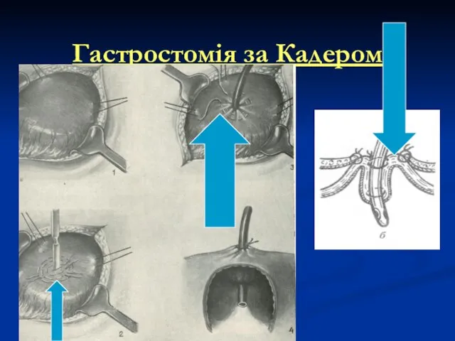 Гастростомія за Кадером