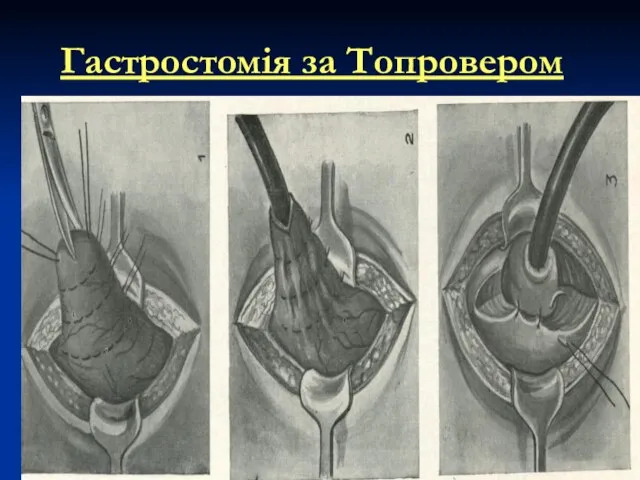 Гастростомія за Топровером