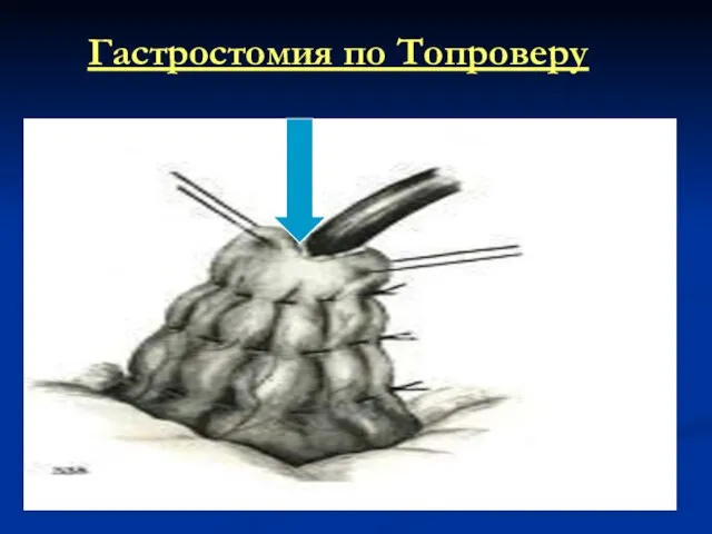 Гастростомия по Топроверу