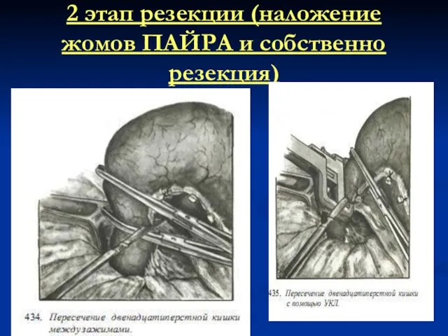 2 этап резекции (наложение жомов ПАЙРА и собственно резекция)