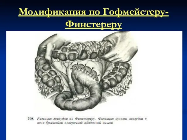 Модификация по Гофмейстеру-Финстереру