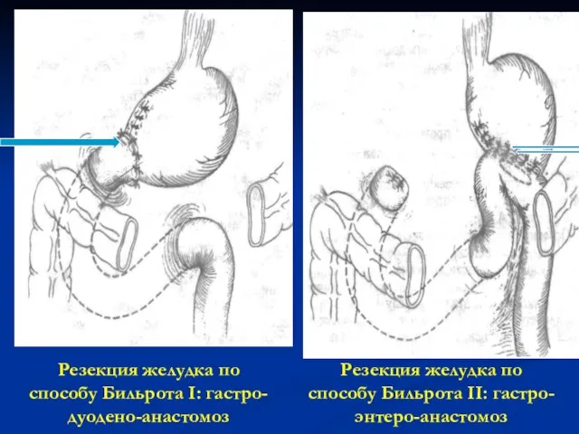 Резекция желудка по способу Бильрота I: гастро-дуодено-анастомоз Резекция желудка по способу Бильрота II: гастро-энтеро-анастомоз