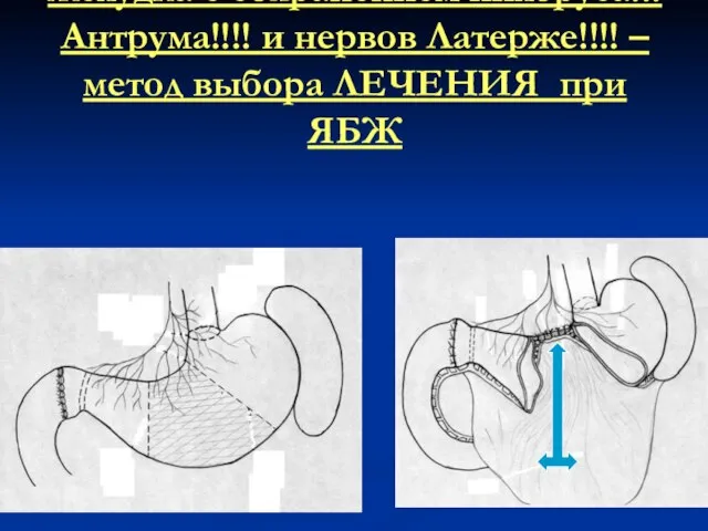 3. Сегментарная резекция тела желудка с сохранением пилоруса!!! Антрума!!!! и нервов Латерже!!!!