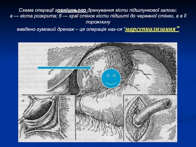 Схема операції зовнішнього дренування кісти підшлункової залози: а — кіста розкрита; б