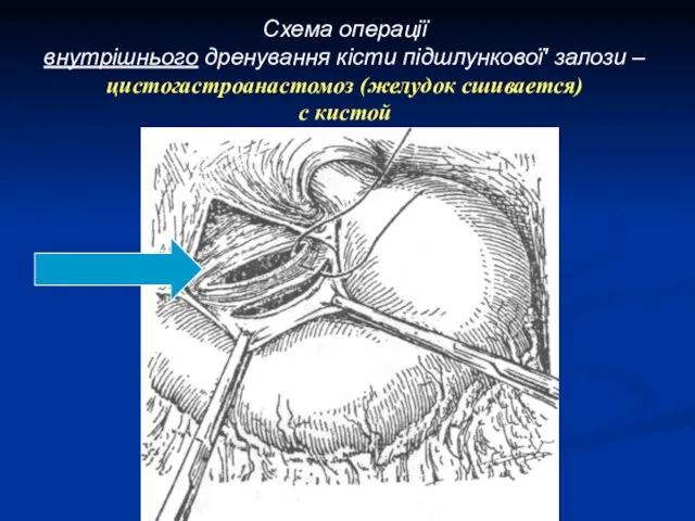 Схема операції внутрішнього дренуван­ня кісти підшлункової' залози –цистогастроанастомоз (желудок сшивается) с кистой