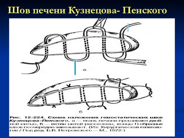 Шов печени Кузнецова- Пенского