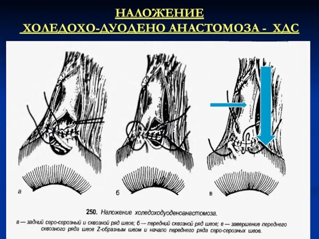 НАЛОЖЕНИЕ ХОЛЕДОХО-ДУОДЕНО АНАСТОМОЗА - ХДС