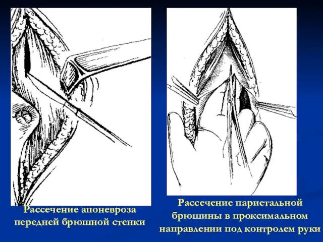 Рассечение апоневроза передней брюшной стенки Рассечение париетальной брюшины в проксимальном направлении под контролем руки