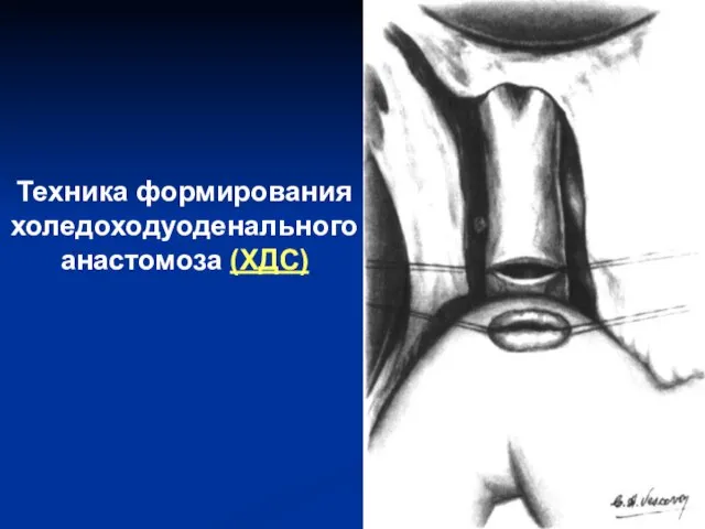 Техника формирования холедоходуоденального анастомоза (ХДС)