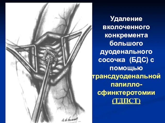 Удаление вколоченного конкремента большого дуоденального сосочка (БДС) с помощью трансдуоденальной папилло-сфинктеротомии (ТДПСТ)