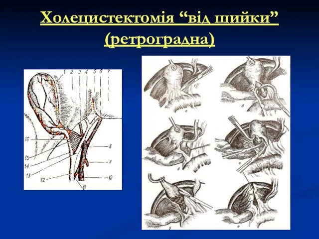 Холецистектомія “від шийки” (ретроградна)