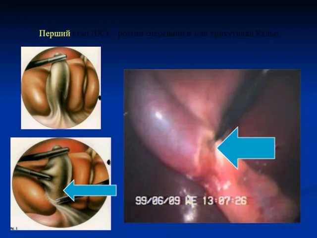 Перший етап ЛХЭ – розтин очеревини в зоні трикутника Кальо.