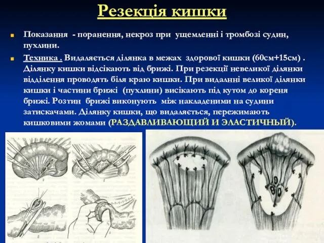 Резекція кишки Показання - поранення, некроз при ущемленні і тромбозі судин, пухлини.