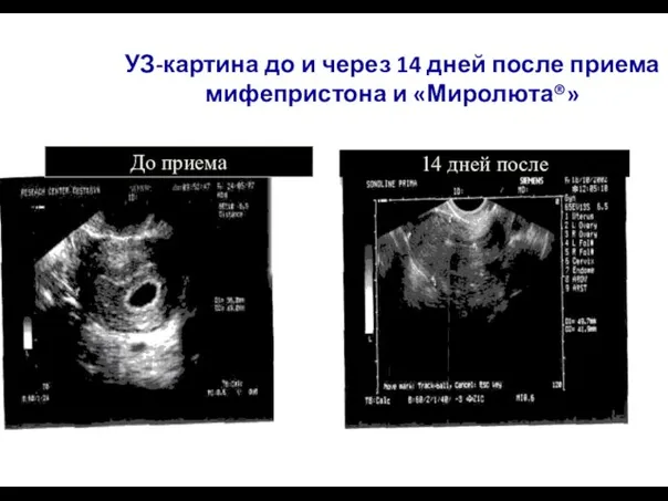 УЗ-картина до и через 14 дней после приема мифепристона и «Миролюта®» До приема 14 дней после