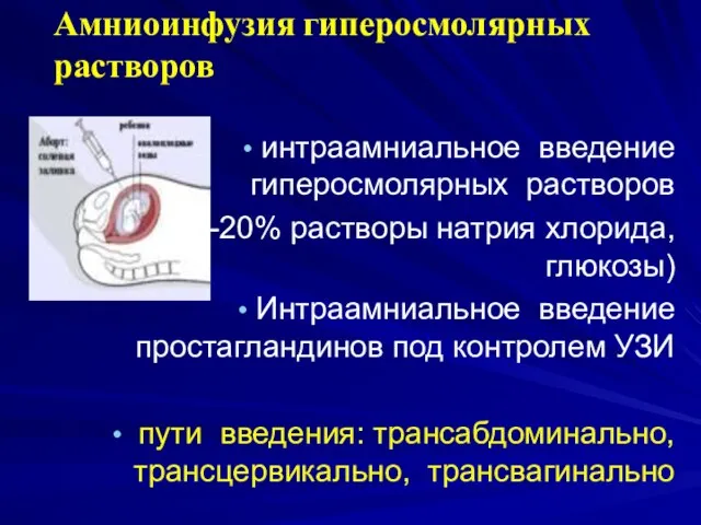 Амниоинфузия гиперосмолярных растворов интраамниальное введение гиперосмолярных растворов (10-20% растворы натрия хлорида, глюкозы)