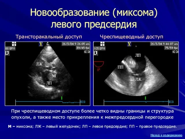 Новообразование (миксома) левого предсердия